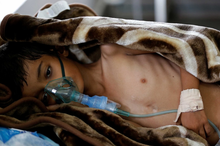 An eight-year-old malnourished boy lies on a bed in the emergency ward of a hospital in Sanaa, Yemen September 27, 2016.