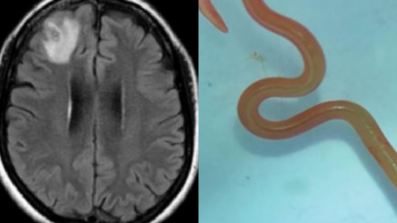 Finding a live brain worm is rare. 4 ways to protect yourself from