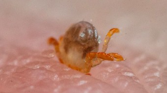 Extreme closeup of a tick burrowing into human skin.