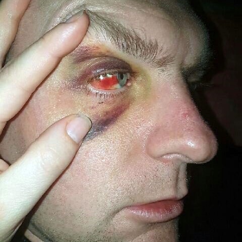 A man holds his badly bruised and red eye up to the camera.