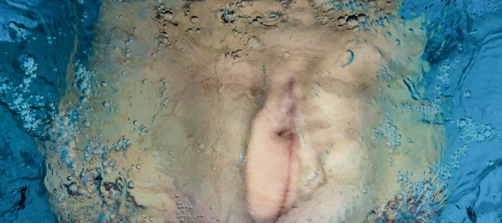 A woman's stomach, with an obvious scar running vertically beside the navel, partly submerged in clear blue water.