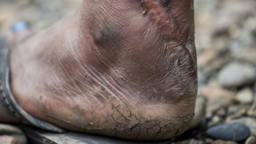 The foot of Ally Komni, beneficiary of Voice for Change, Kilbang Village.