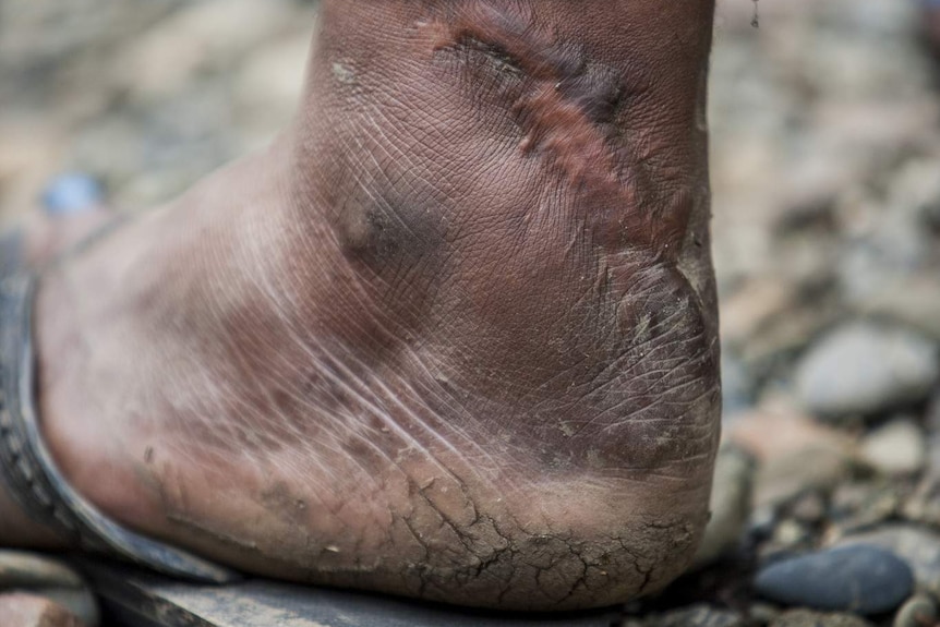 The foot of Ally Komni, beneficiary of Voice for Change, Kilbang Village.