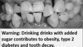 Damaged teeth with a written warning about tooth decay associated with sugar-sweetened drinks.