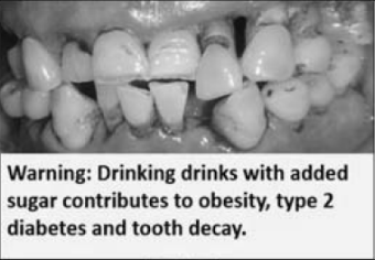 Damaged teeth with a written warning about tooth decay associated with sugar-sweetened drinks.