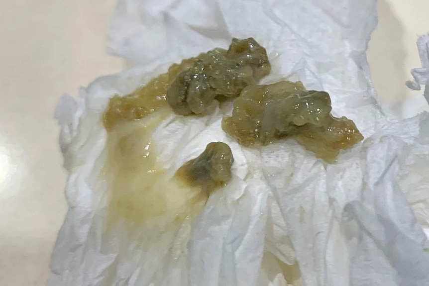 Sputum from a person with aspergillosis which has mould growing on the phlegm