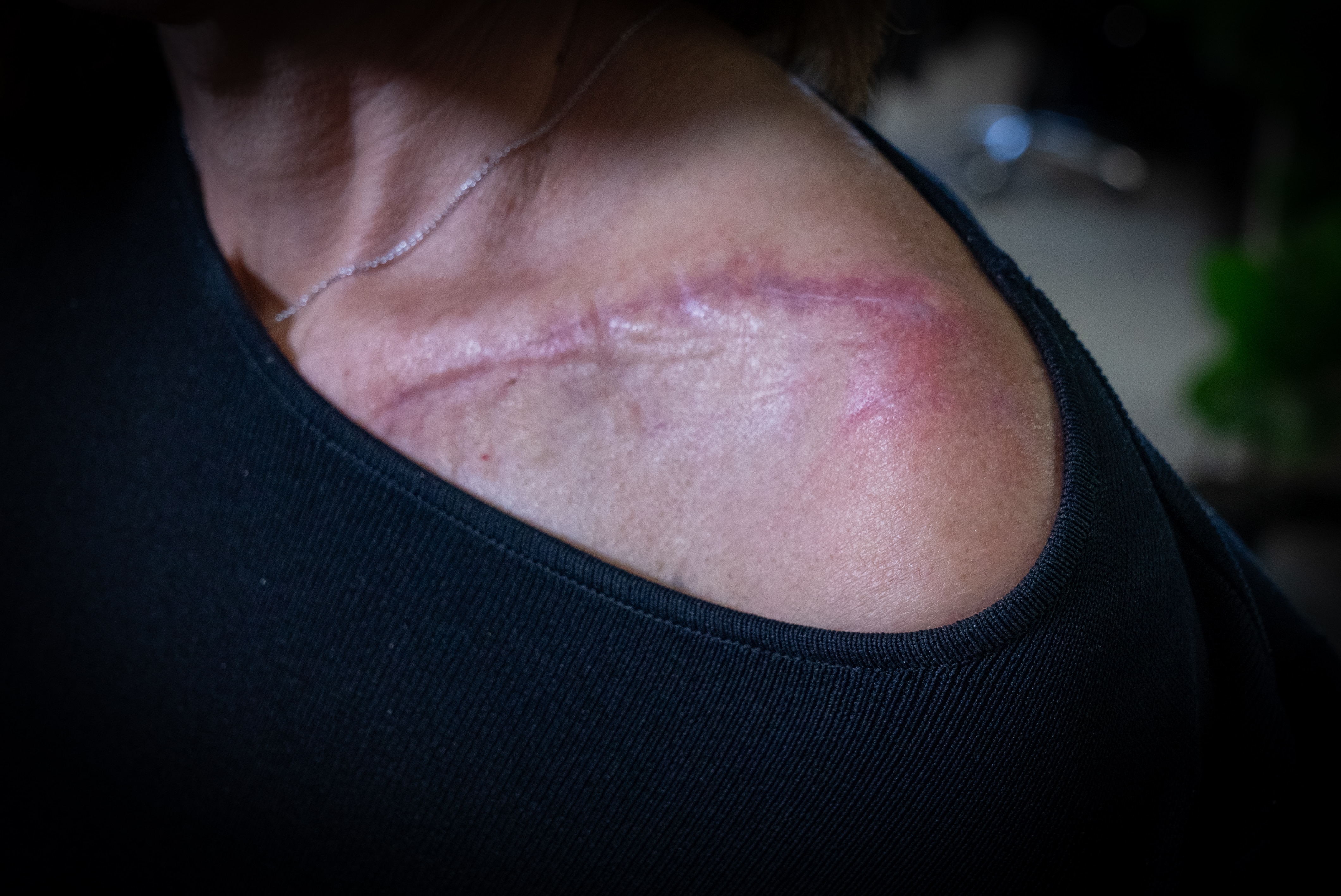 A woman with brown hair in a black top shows a bandage on her collarbone.