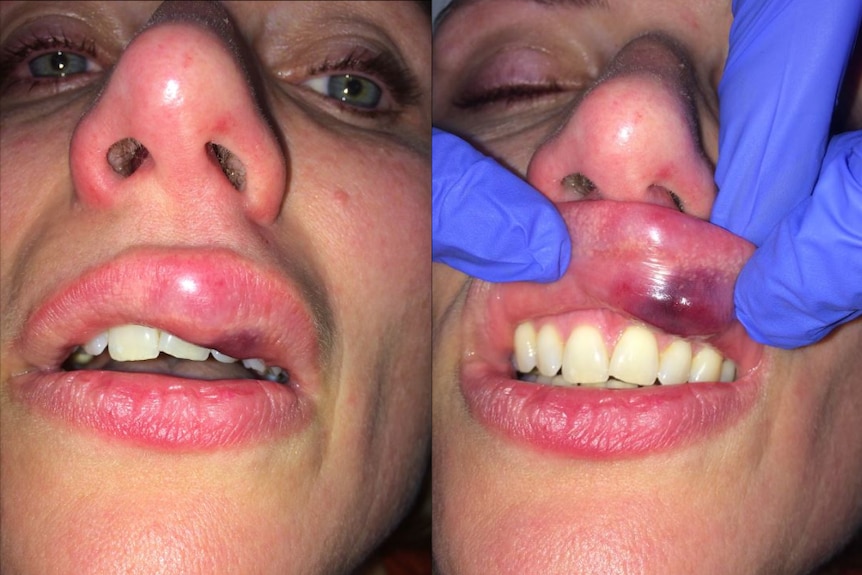 A closeup of Kim Proudlove's swollen lip.