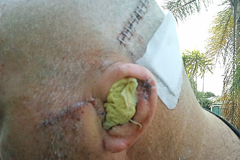 Stitches across a man's head and ear
