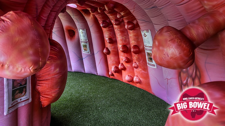 An inflatable Big Bowel that people can walk through, showing polyps and cancerous growths