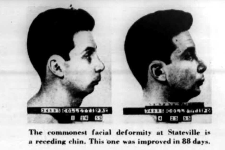 Black and white before and after side-profile shots of two men, one with straightened nose and one with chin brought forward.