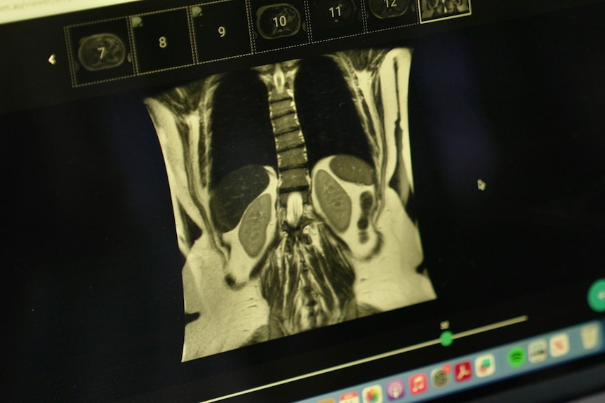 An MRI scan of the pelvis area displays on a screen.