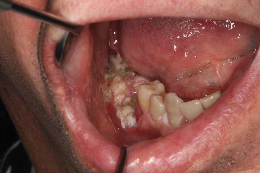 患者口腔内的医学特写，牙齿周围的组织癌变并充满脓液