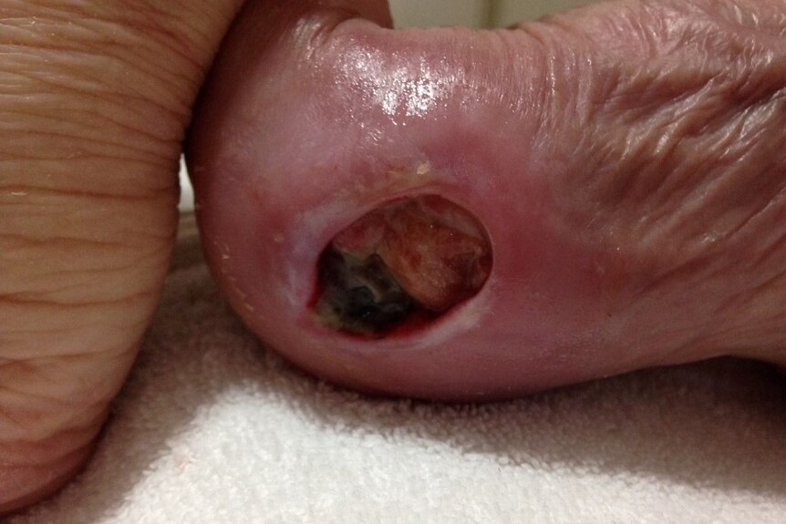 An ulcer on an elderly woman's foot.