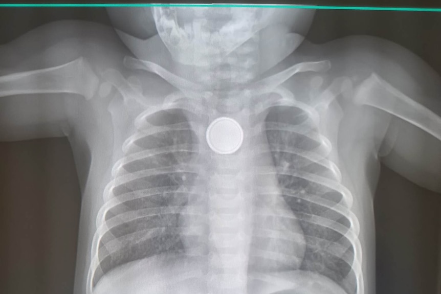 An x-ray of a child's rib cage that clearly shows a foreign circular object inside