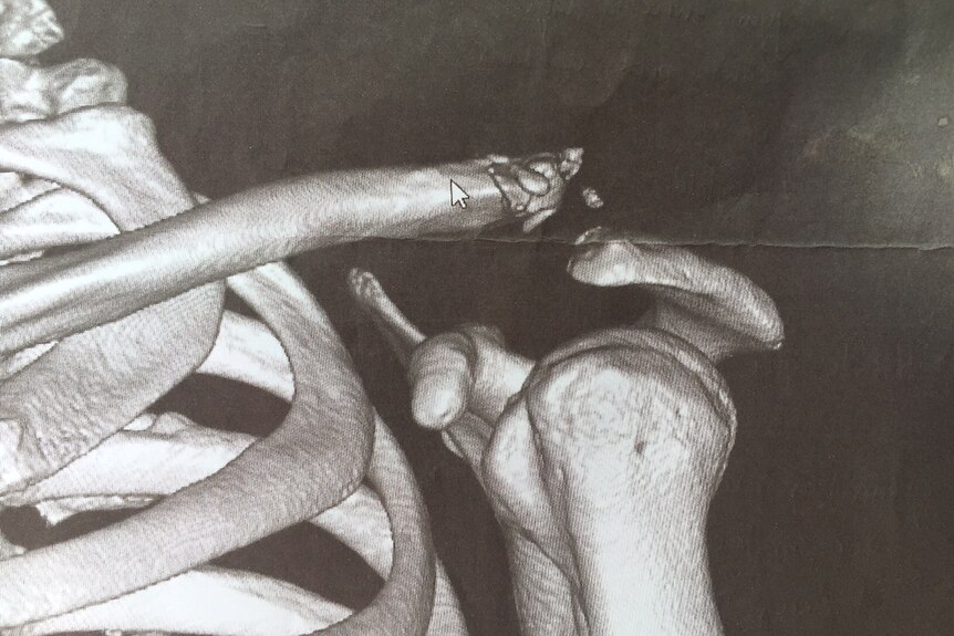 X-ray of Glenn Randall's collarbone