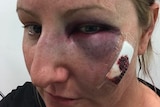 A photo of Samantha Mitchell with a bruised eye and cut on her face.