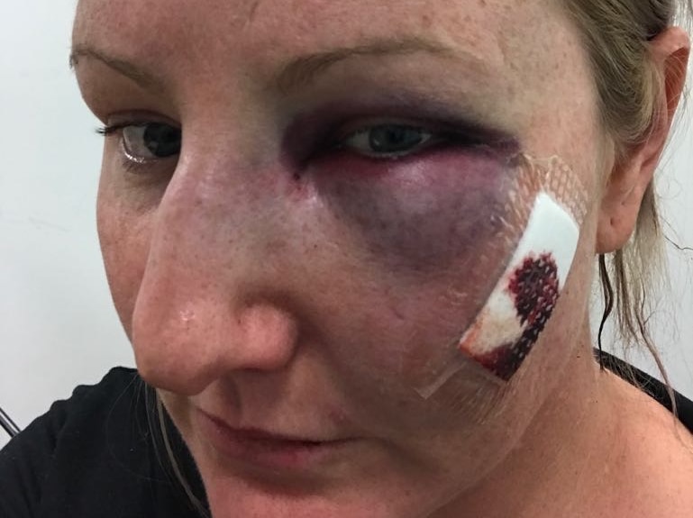 A photo of Samantha Mitchell with a bruised eye and cut on her face.