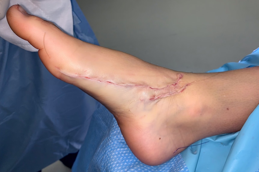 A foot with a long shark bite scar