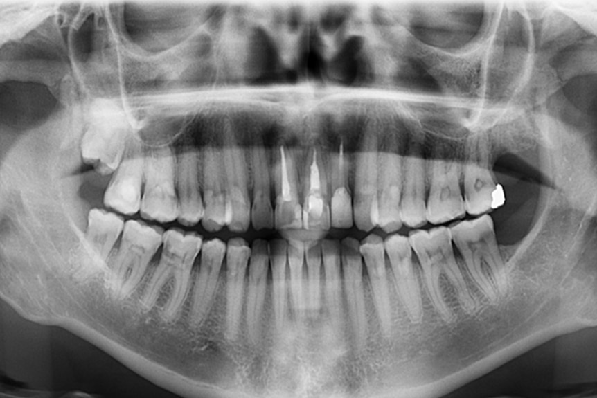 The X- Ray shows three upper front teeth that have been damaged as a result of trauma.