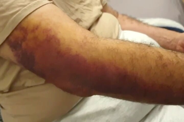 A man's arm, which has been bruised.