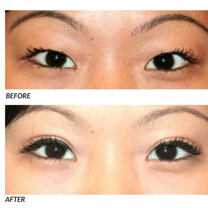 A before and after showing how double eyelid surgery can change the shape of the eye.