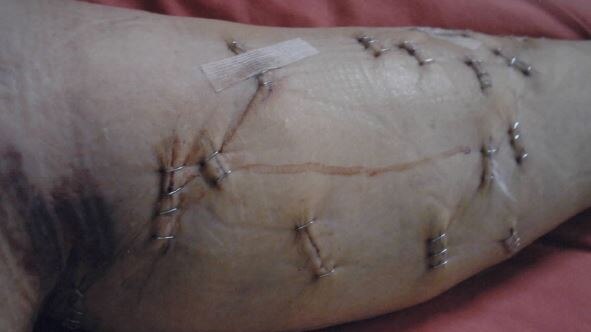 A woman's leg with more than a dozen cuts, bruising and staples.