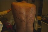 An Australian Tamil man, known as Kumar, shows marks on his back he suffered when he was tortured with hot irons in Sri Lanka.