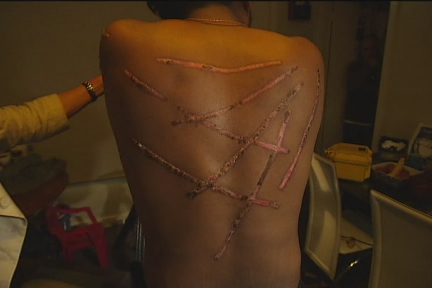 An Australian Tamil man, known as Kumar, shows marks on his back he suffered when he was tortured with hot irons in Sri Lanka.