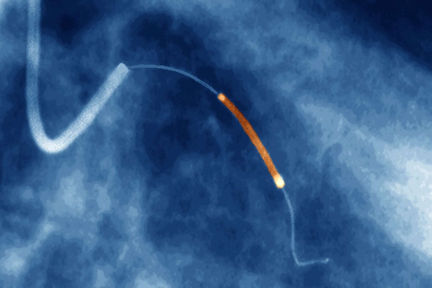 Balloon catheter and stent in a heart artery