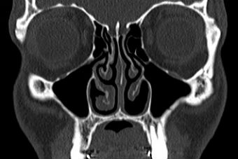 Empty nose syndrome scan