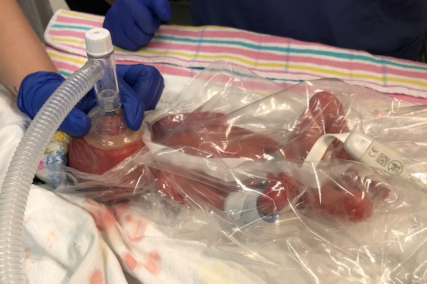  Premature baby Rafferty Robb in humidcrib with oxygen mask