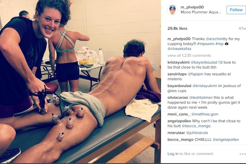 A woman putting cups on the back of Michael Phelps' legs