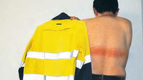 An unidentified man with a striped burn across his back holding a high-vis shirt.
