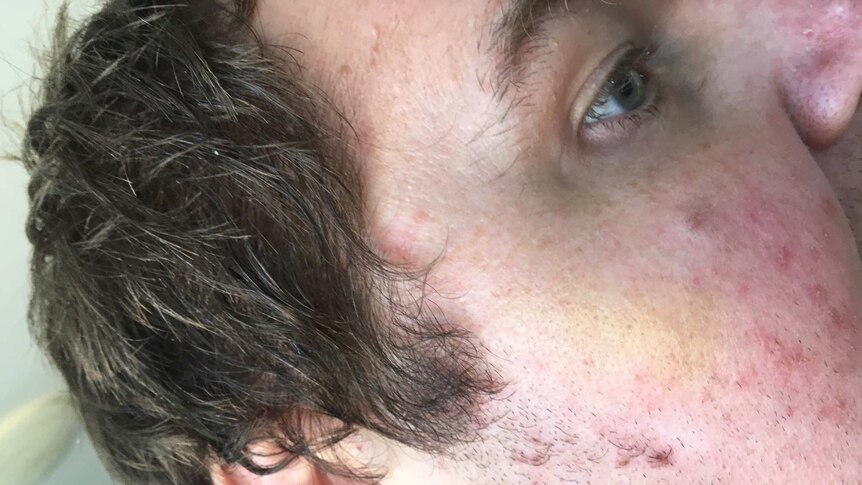 A closeup of the right side of a man's face. His cheek and eye socket are bruised.