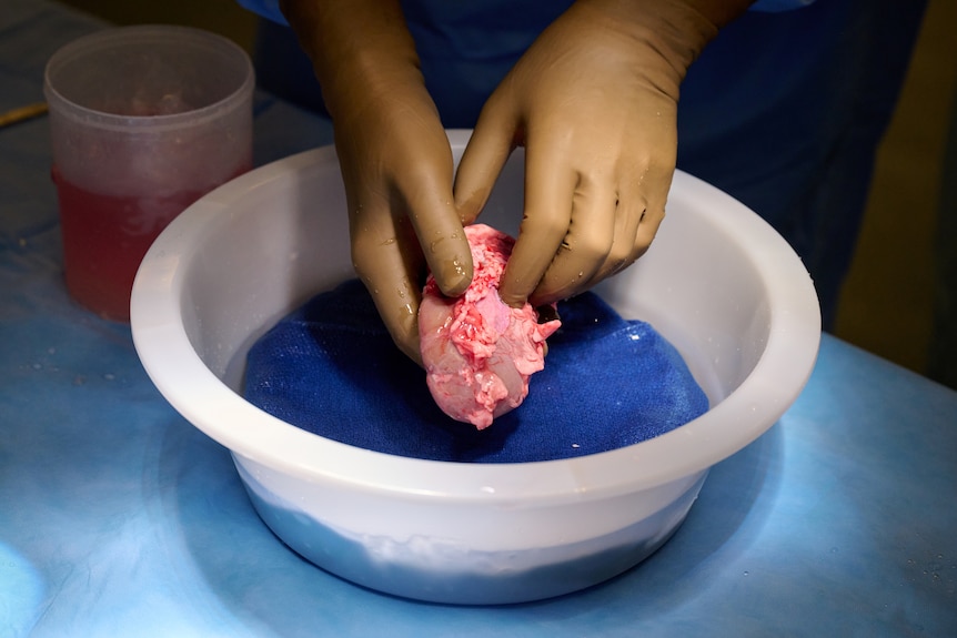 Two hands pick up a kidney from a plastic bowl in an operating room.