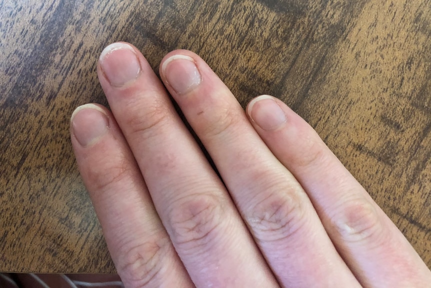 Don't know how to stop biting your nails? Here's what worked for me - ABC  Everyday