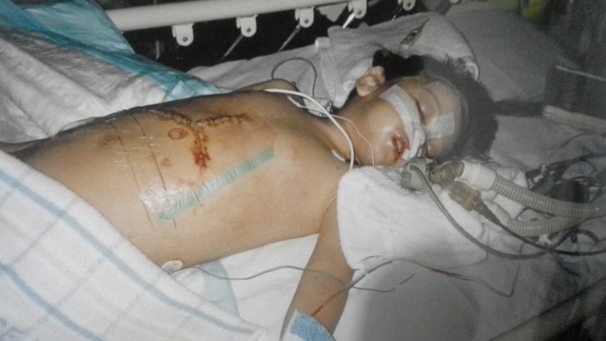 A young girl in hospital bed after surgery
