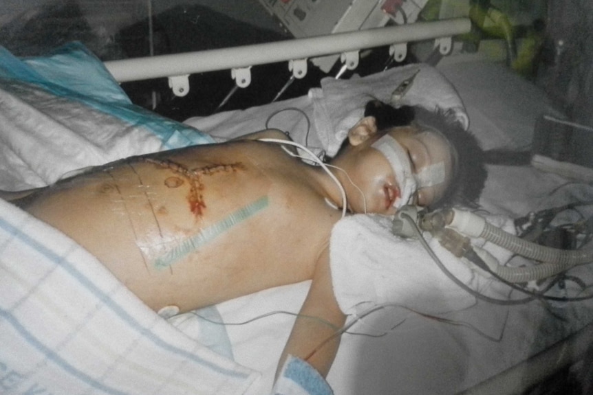 A young girl in hospital bed, with a large stitched scar across her body and breathing tubes attached to her face  after surgery