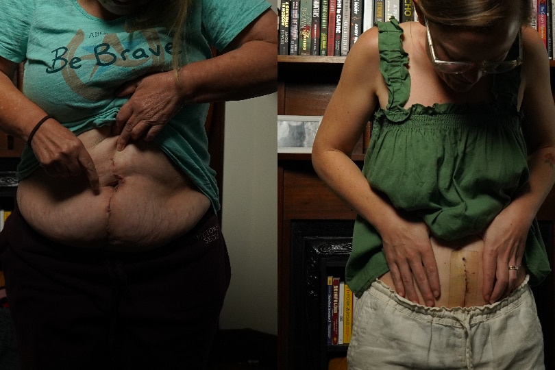 Composite of two women showing scars on their lower abdomen from a uterus transplant surgery.