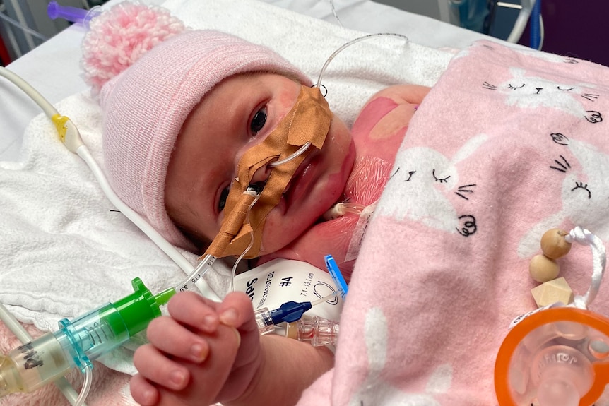A baby in hospital with tubes attached to her nose, holding onto a finger 