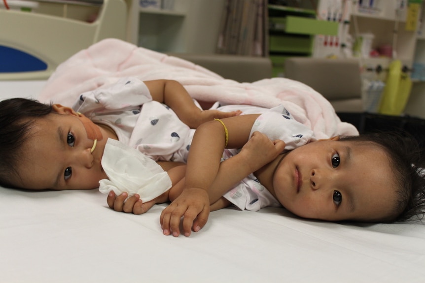 Twin conjoined twins look straight ahead as they lie on a hospital bed