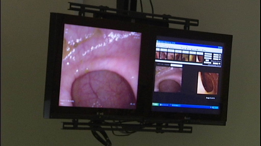 Surgery screen during colonoscopy.