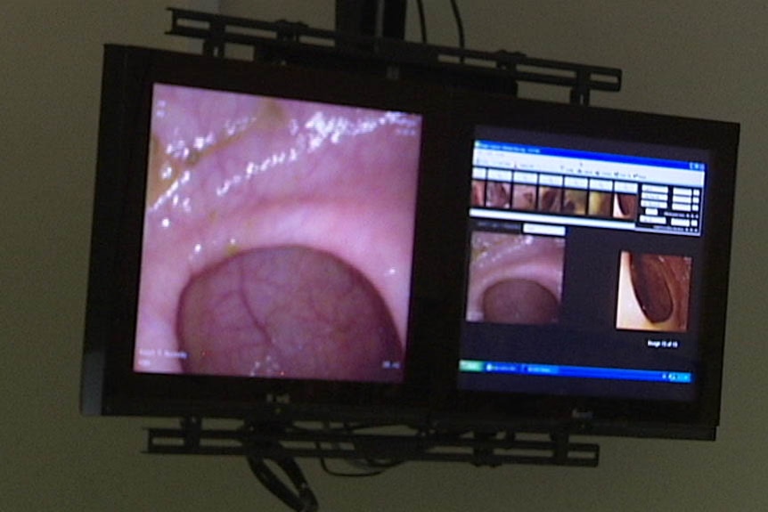 Surgery screen during colonoscopy.