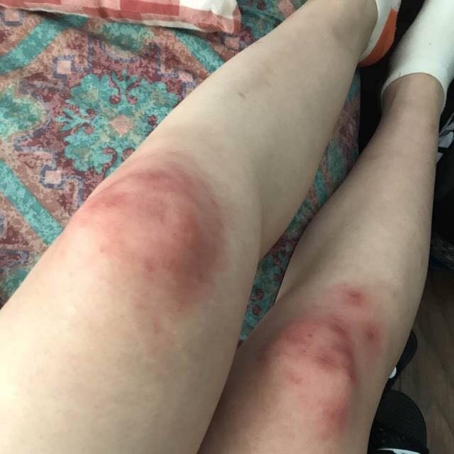 A girl's legs with bruised knees.
