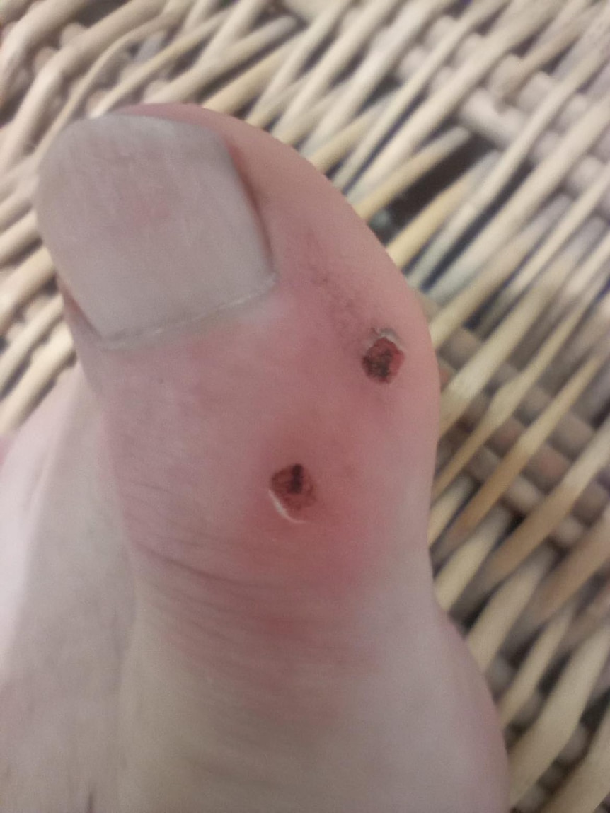 close up of a toe with two small puncture words