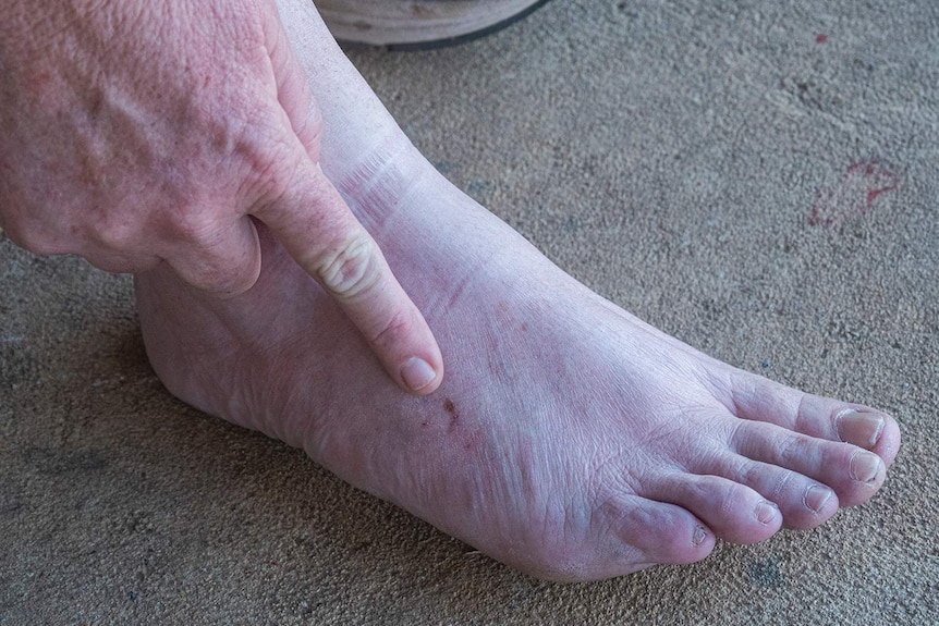 A lady point to a bite mark on her foot