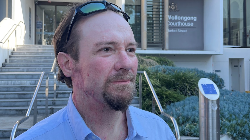 A man posing outside Wollongong court with burn injuries to his face, neck and chest.