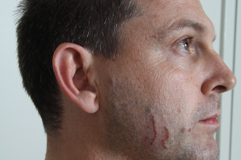 A court photo shows marks on the face of accused murderer Gerard Baden-Clay.