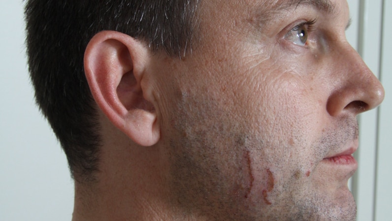 A court photo shows marks on the face of accused murderer Gerard Baden-Clay.
